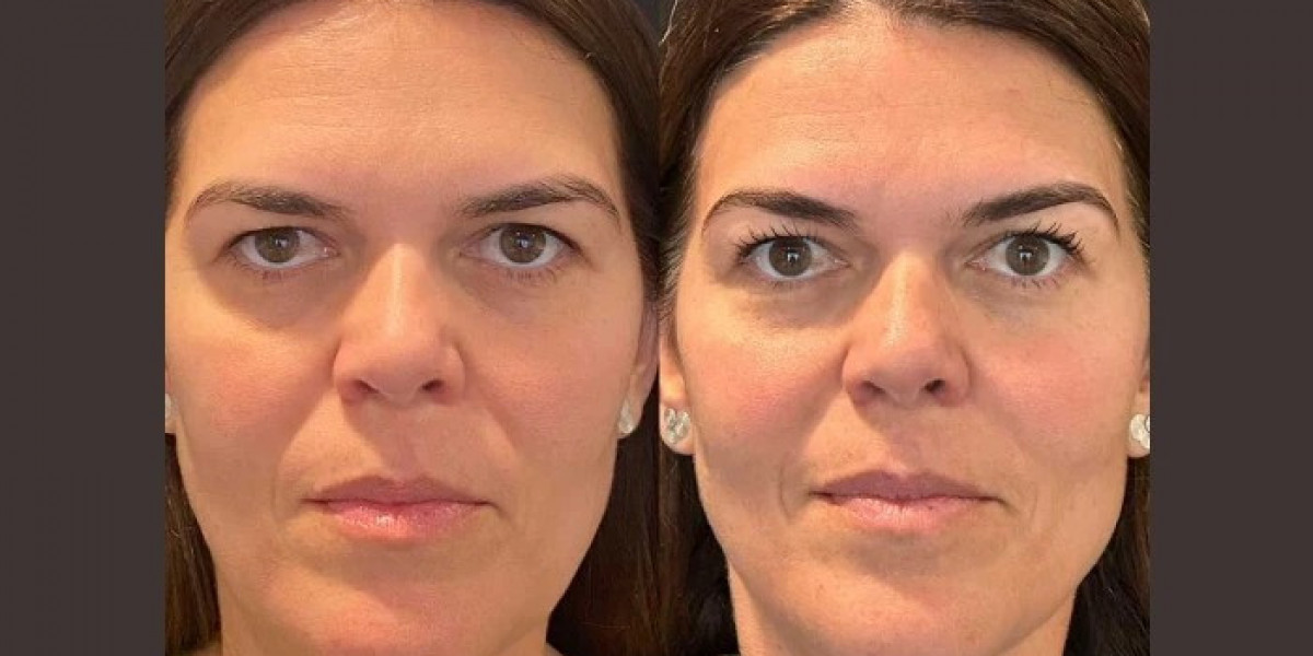 Thread Lift Treatments in Dubai: Smooth Youthful Contours Without Surgery