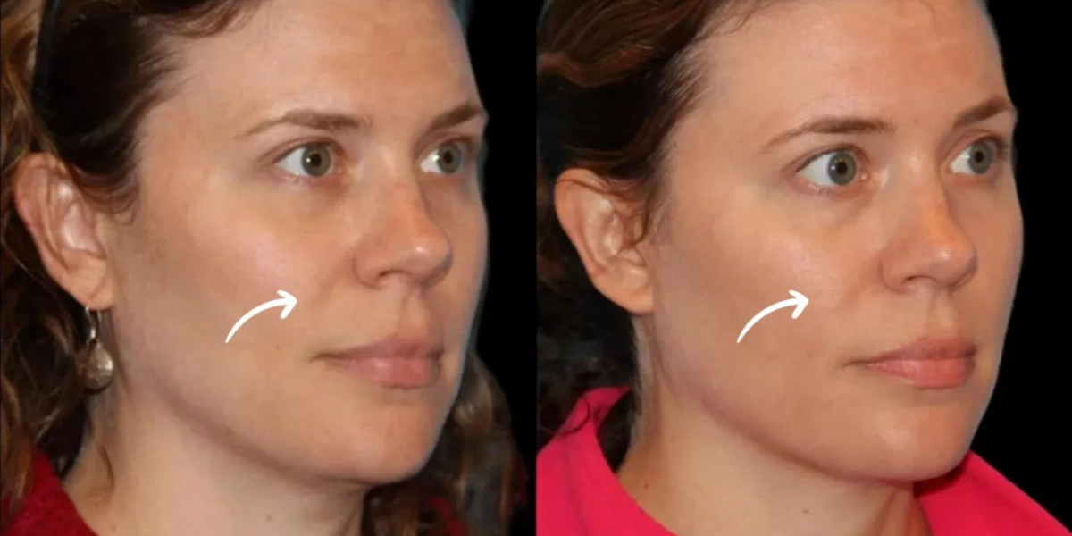 Sculptra Treatments in Dubai for Luxury Wellness