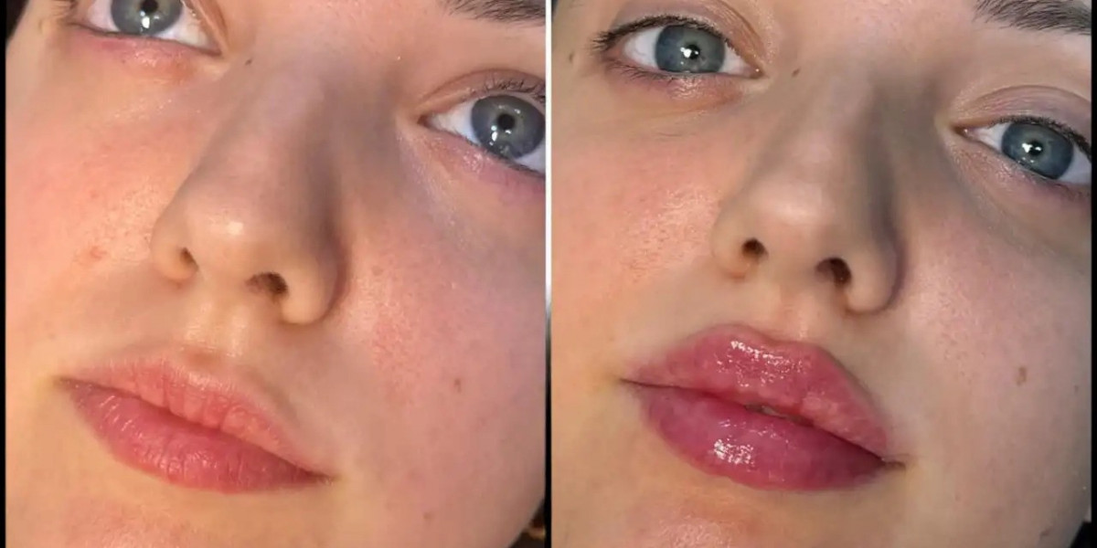 Fillers Treatments in Dubai and Body Contouring
