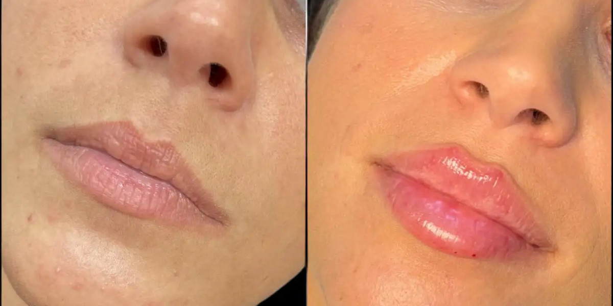 Dermal Fillers Treatments in Dubai for Face Rejuvenation Without Surgery