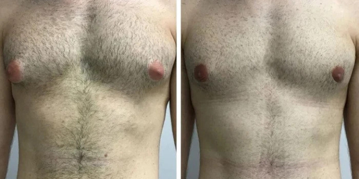 Gynecomastia Surgery in dubai Healthy Habits That Maintain Long Lasting Results