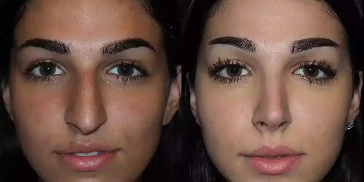 Best Rhinoplasty Surgeon in Dubai: Expert Tips for First-Time Patients