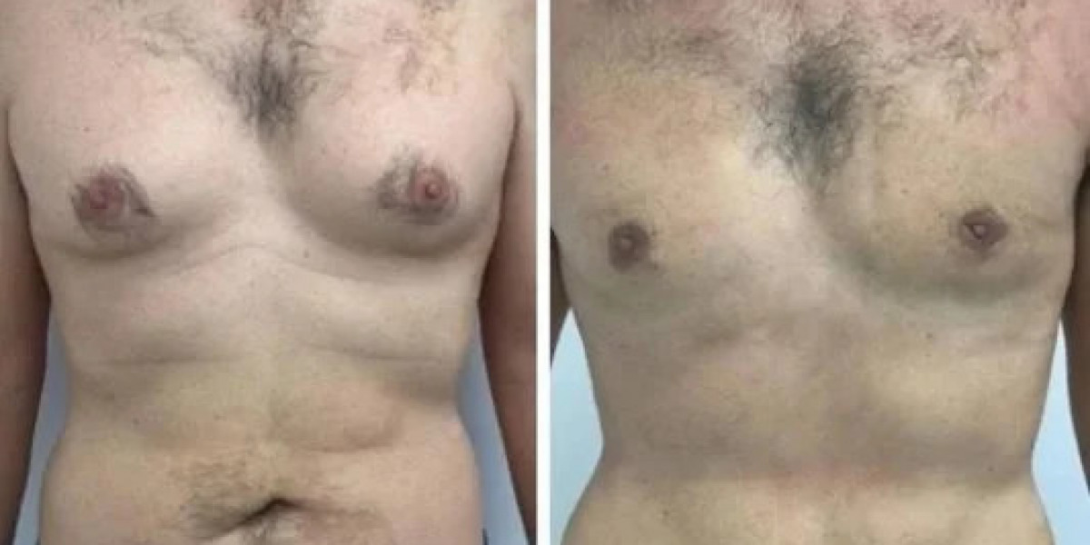 Best Gynecomastia Surgeons in Dubai: Achieving Confidence Through Expert Care