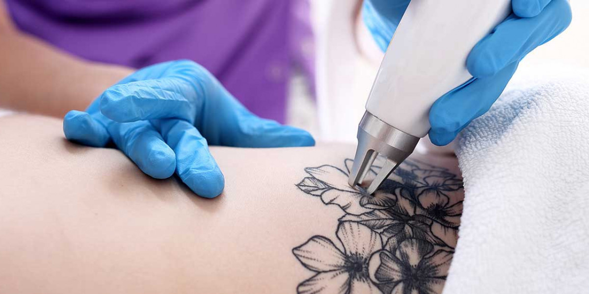 Tattoo Removal in Islamabad: Safe Solutions for a Fresh Start
