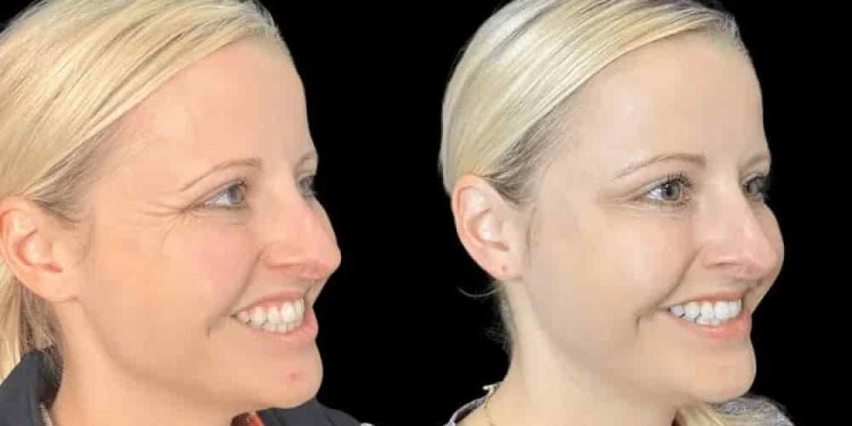 Best Plastic Surgeons in Dubai for Botox to Maintain a Fresh Appearance