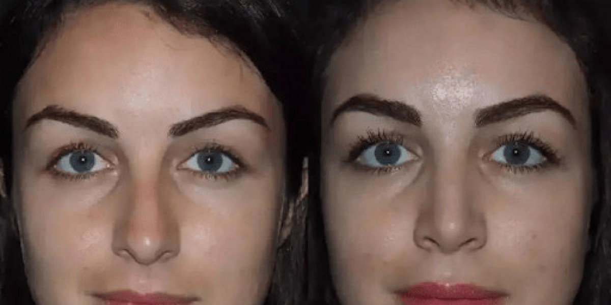 Rhinoplasty in Dubai: How to Select the Best Surgeon for Your Goals