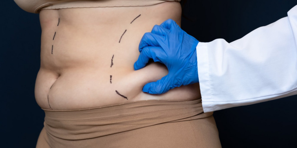 Different Types of Liposuction Techniques Explained