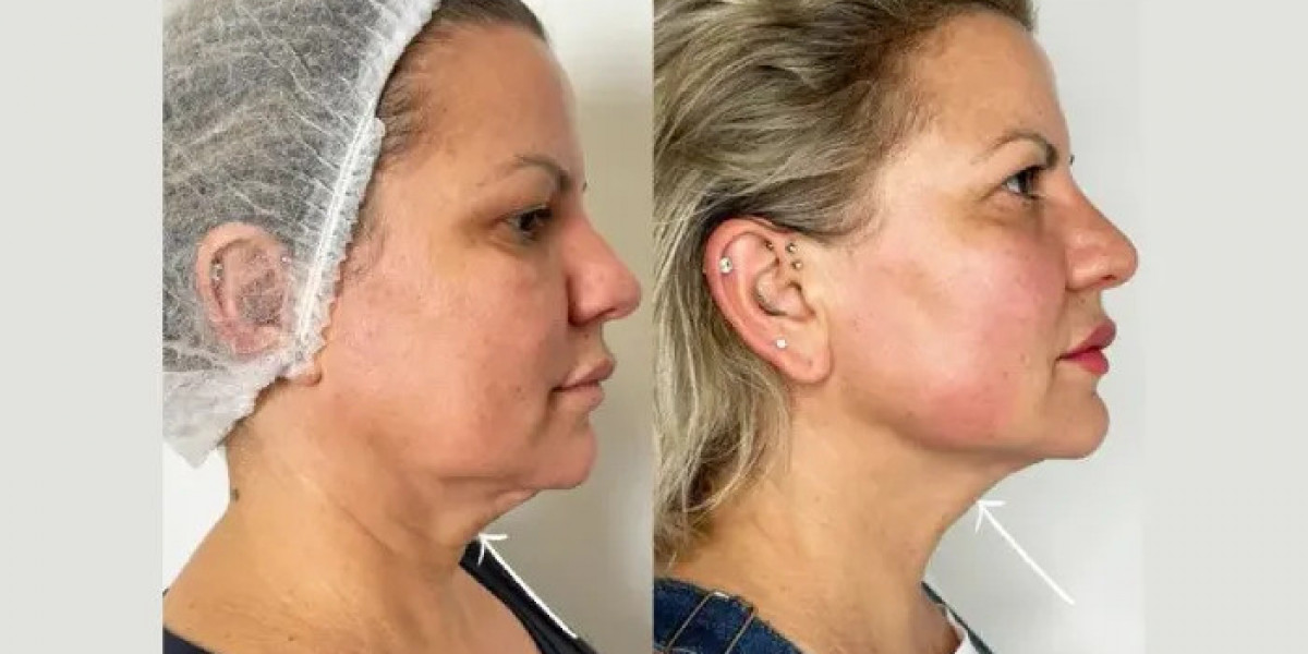 How Endolift Treatments in Dubai Improve Jawline Definition