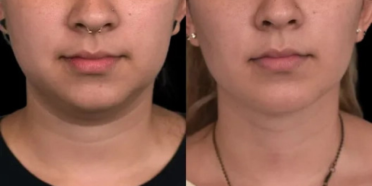 Best Double chin removal Surgeon in dubai Guide!