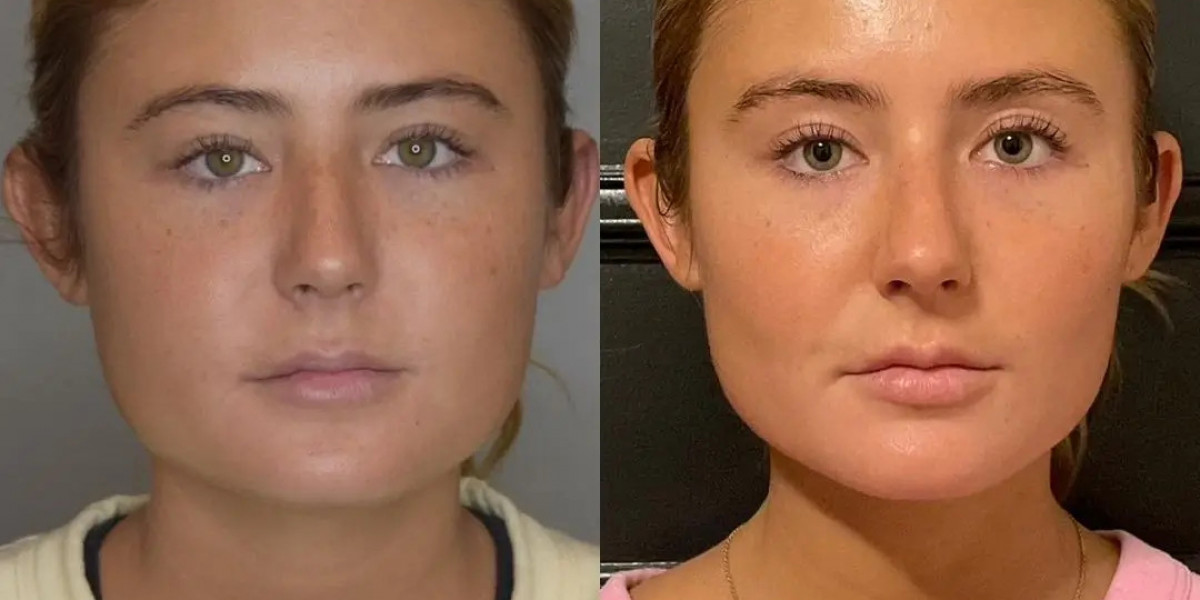Best Buccal fat removal Surgeon in dubai Best Results