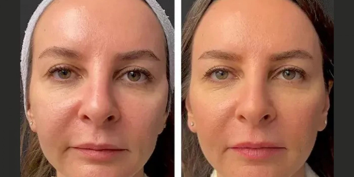 Best Doctors in Dubai for Mesotherapy: Choosing the Right Specialist
