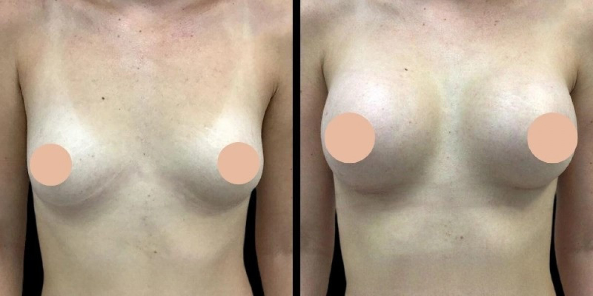 Best Breast Augmentation Surgeons in Dubai: Advanced Technology