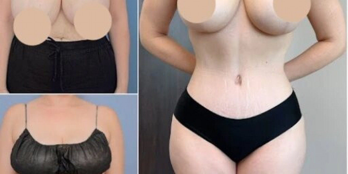 Discover Confidence Through Best Tummy Tuck Surgeons in Dubai