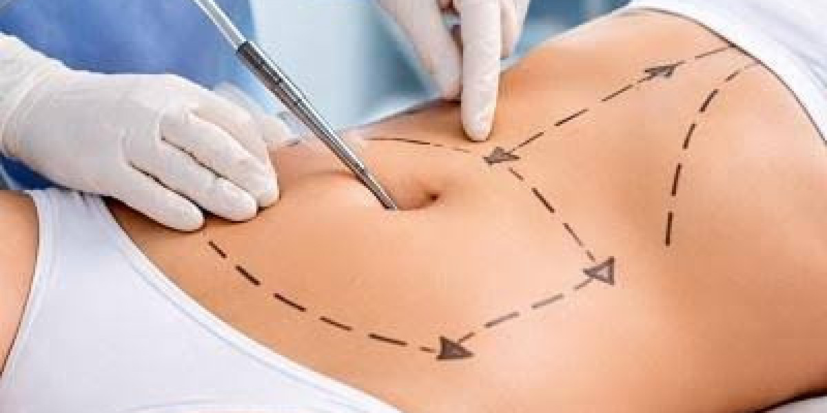 Liposuction Surgery in Dubai: Improving Body Definition