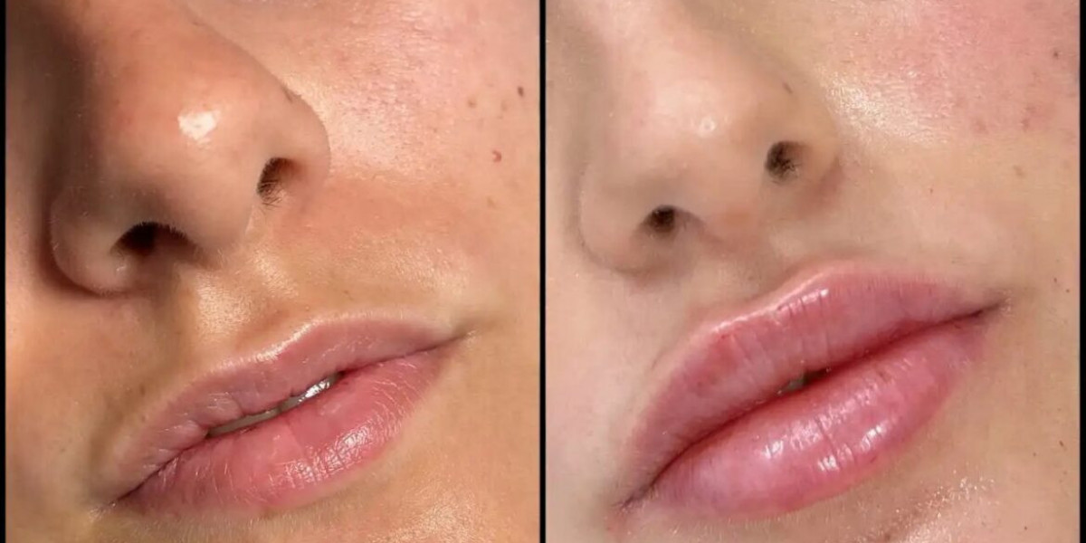 Fillers Treatments in Dubai for Natural-Looking Volume Restoration