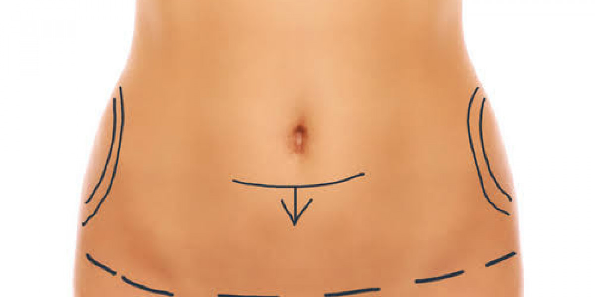 Abdominoplastie à Paris: Retrouvez une silhouette abdominale plus harmonieuse