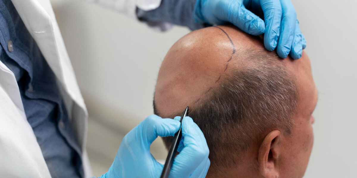 Could FUE Strengthen a Thinning Front?