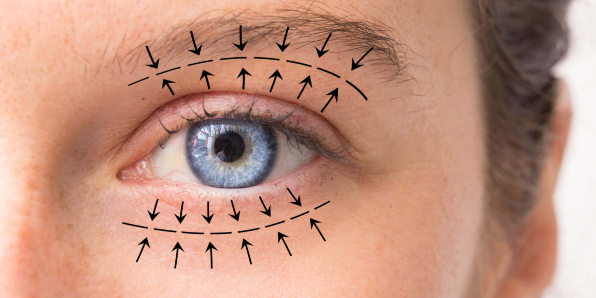 Can Eyelid Surgery Give You a Fresher Appearance?